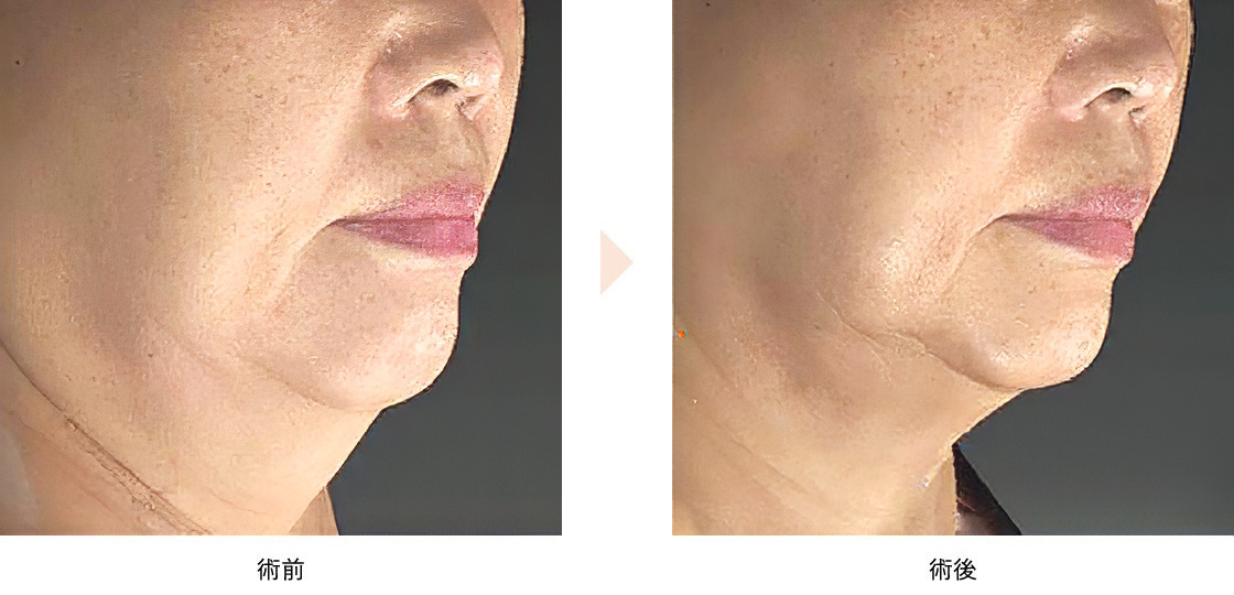 アグネス（切らない顎下のたるみ取り）の症例写真・ビフォーアフター