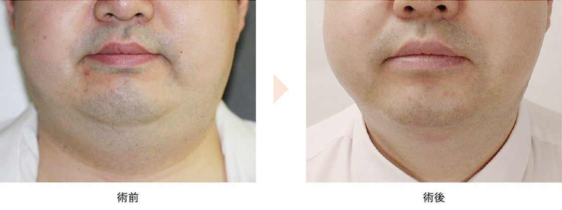 二重顎治療（アグネス）※2回施術の症例写真・ビフォーアフター