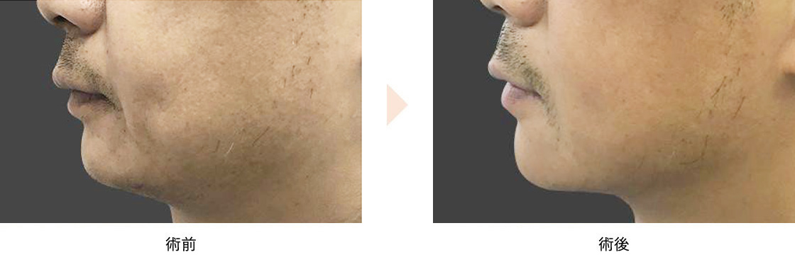 顎下のたるみ治療（アグネス）の症例写真・ビフォーアフター