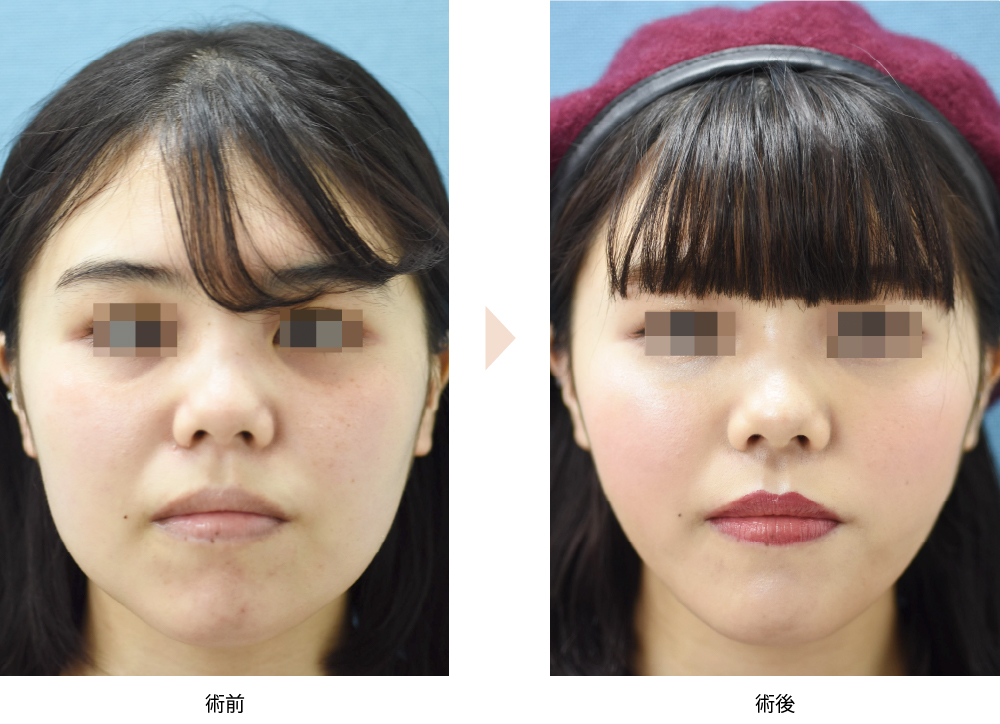 頬の脂肪吸引（ベイザー使用）（No.202）（ジョールファット除去による小顔・顔痩せ治療）の症例写真・ビフォーアフター