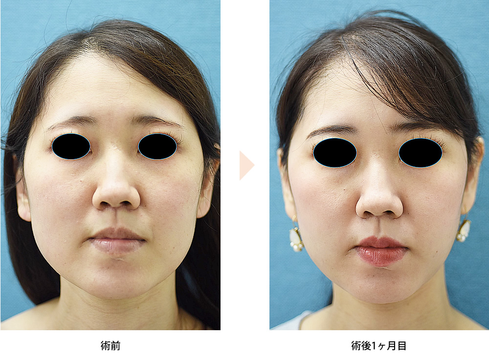 頬の脂肪吸引（No.205）（ジョールファット除去による小顔・顔痩せ治療）の症例写真・ビフォーアフター