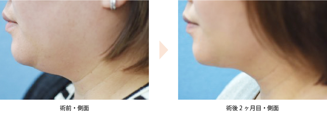 【頬・首の脂肪吸引】（No.）（ジョールファットと首回りの脂肪吸引による小顔治療）の症例写真・ビフォーアフター
