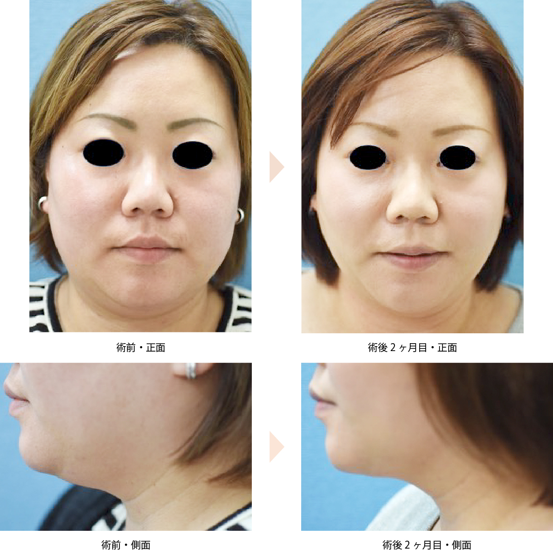 頬・首の脂肪吸引（No.207）（ジョールファット除去と首回りの脂肪吸引による小顔・顔痩せ治療）の症例写真・ビフォーアフター