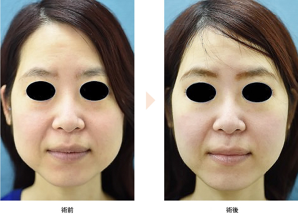 頬の脂肪吸引（No.214）（ジョールファット吸引による小顔治療）の症例写真・ビフォーアフター