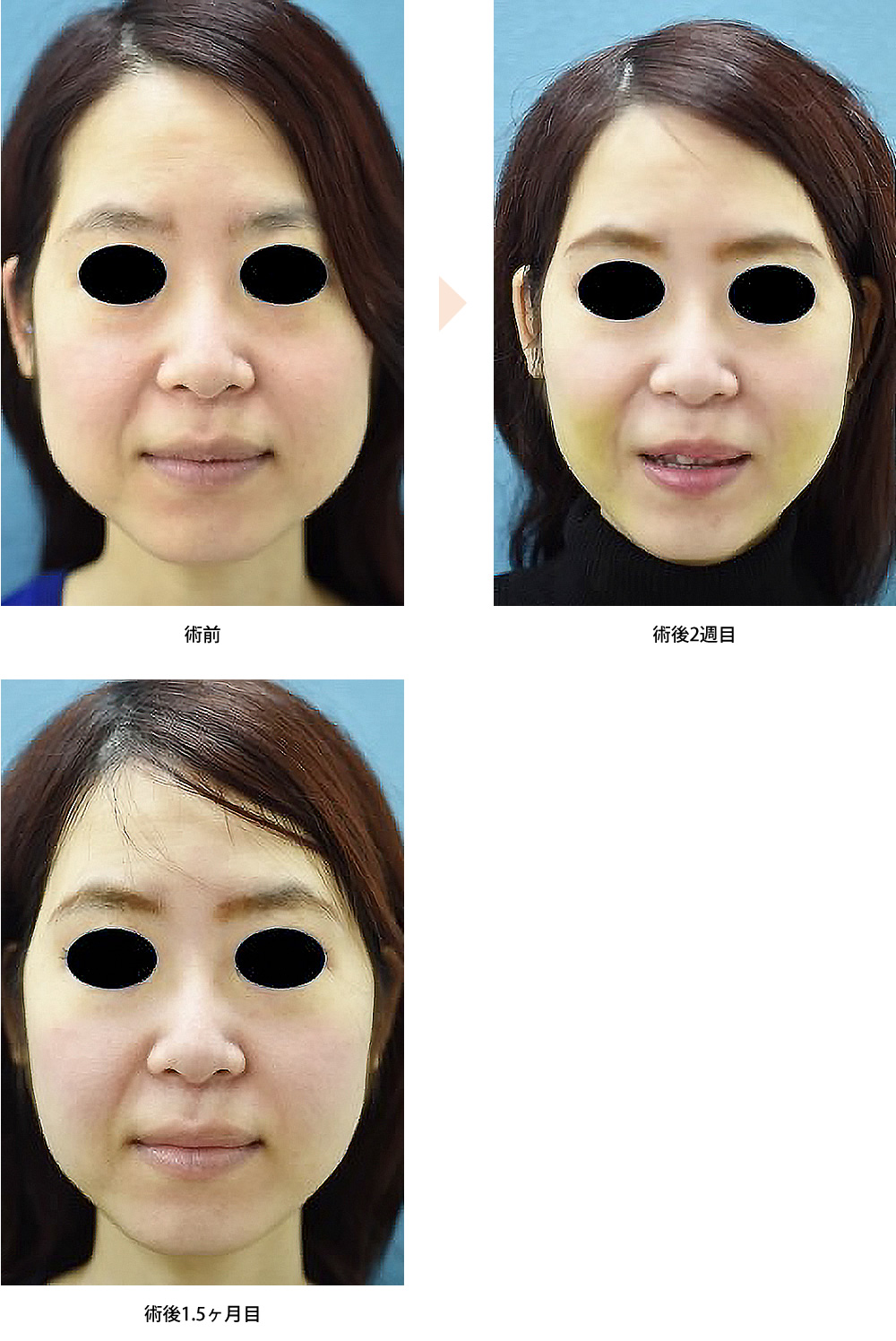 頬の脂肪吸引（No.214）（ジョールファット吸引による小顔治療）の症例写真・ビフォーアフター