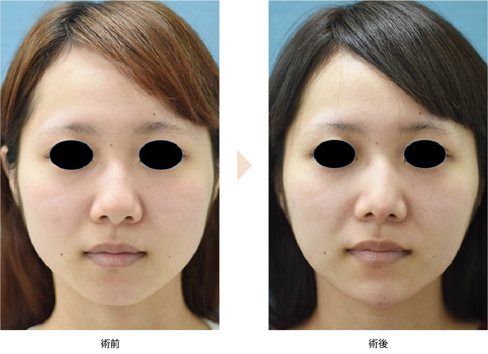 頬の脂肪吸引・エラボトックス（No.218）（ジョールファット除去・咬筋ボトックスによる小顔・顔痩せ治療）の症例写真・ビフォーアフター