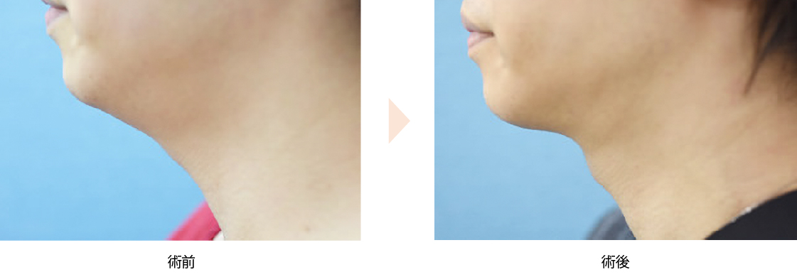 【顎下の脂肪吸引】（No.）（ジョールファット除去による小顔治療）」の症例写真・ビフォーアフター