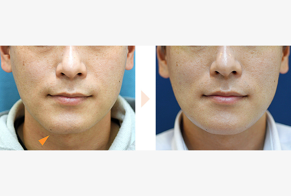 おとがい形成（顎先の左右差改善）の症例写真・ビフォーアフター