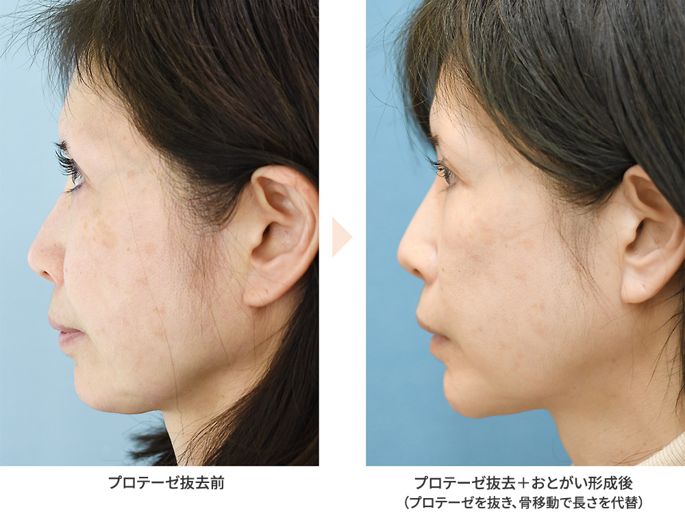 プロテーゼ抜去＋おとがい形成術（No.640）（顎プロテーゼ抜去後の再修正術）の症例写真・ビフォーアフター