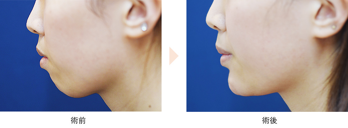 顎プロテーゼによるEライン形成（No.647）（手術ナシ・最大限に顎を前に出す）の症例写真・ビフォーアフター