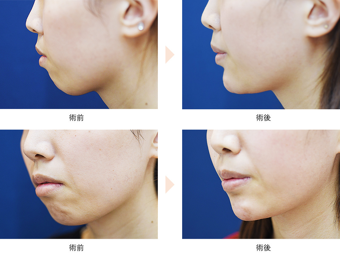 顎プロテーゼによるEライン形成（No.647）（手術ナシ・最大限に顎を前に出す）の症例写真・ビフォーアフター