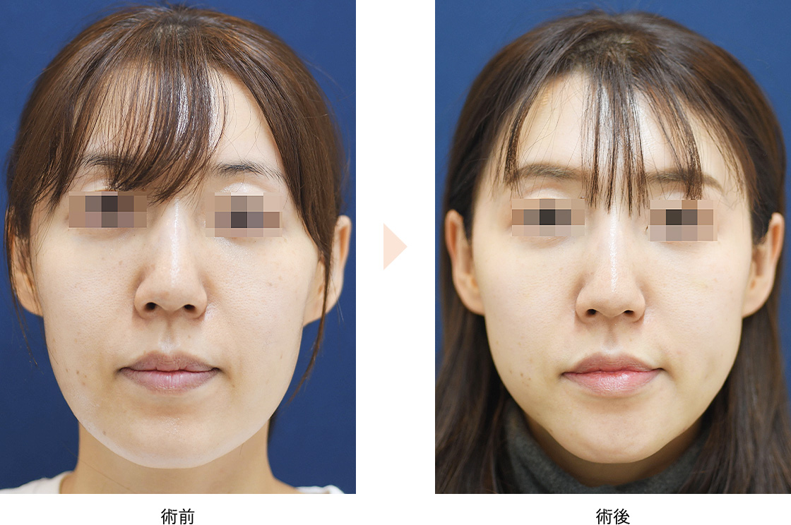 Vライン形成術(No.655)(U字型の大きな顎をVラインに)の症例写真・ビフォーアフター