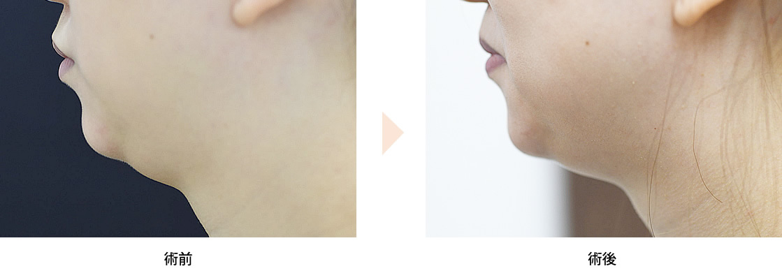 クールスカルプティング・エリート（No.260）（脂肪冷却マシンによる顎下の脂肪除去）の症例写真・ビフォーアフター