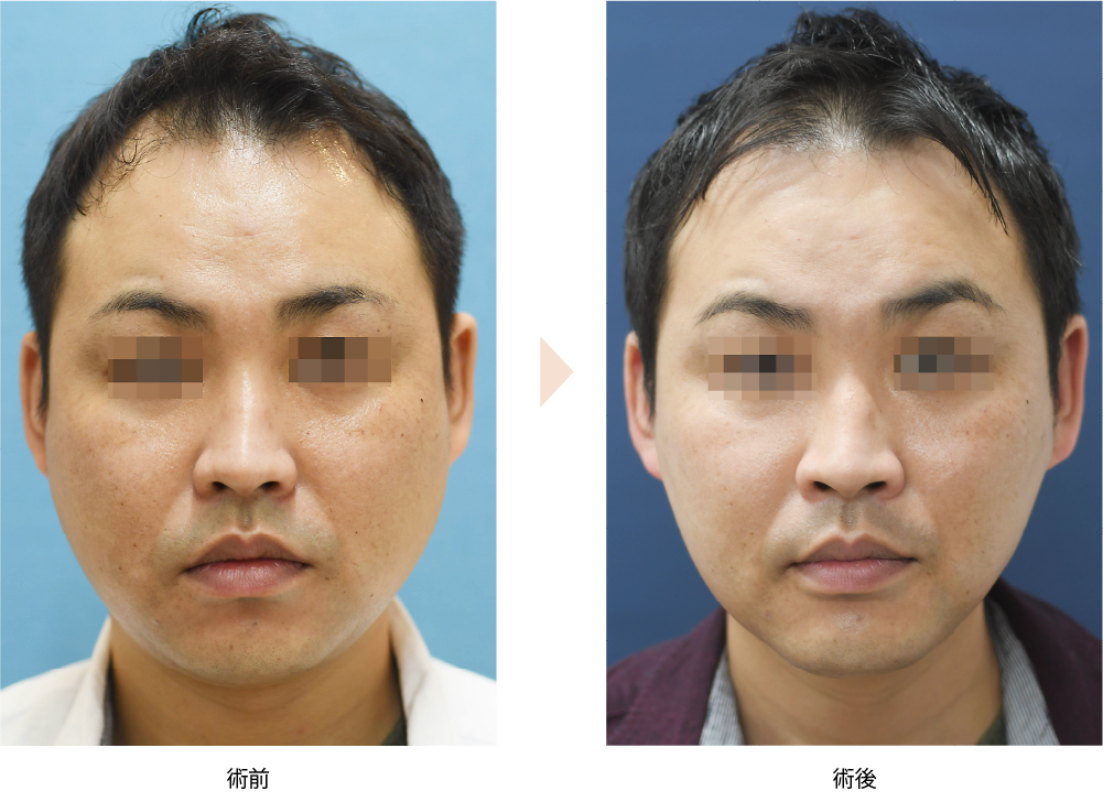 クールスカルプティング・エリート（No.256）（脂肪冷却マシンによる頬・顎下の脂肪除去）の症例写真・ビフォーアフター