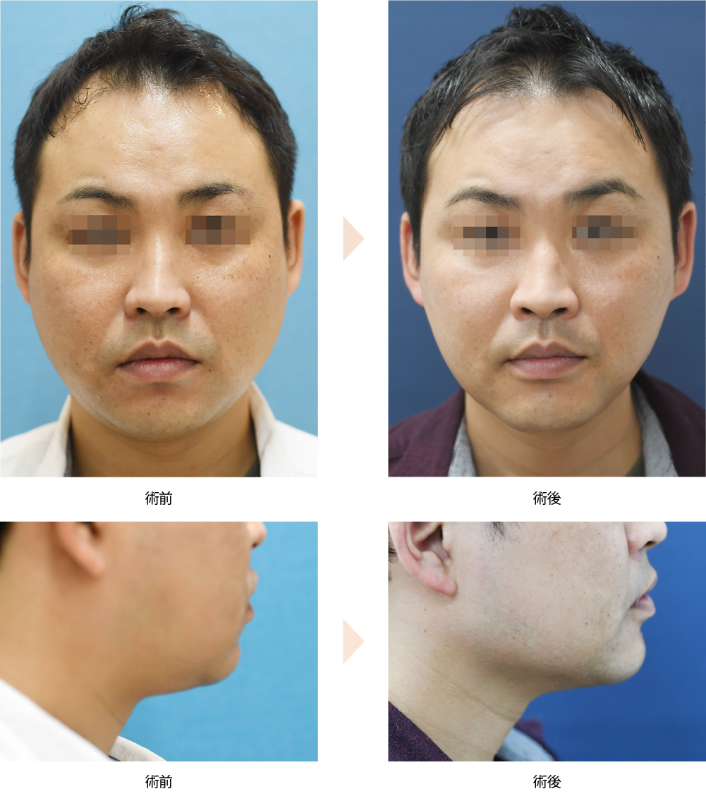 【クールスカルプティング・エリート】（No.）（頬・顎下の小顔治療）の症例写真・ビフォーアフター