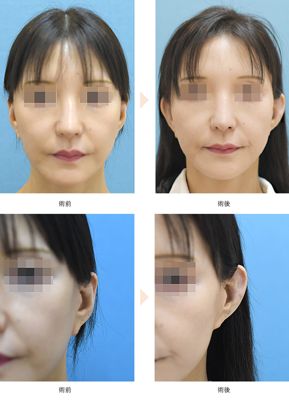 立ち耳整形（小顔・幼な顔効果）の症例写真・ビフォーアフター