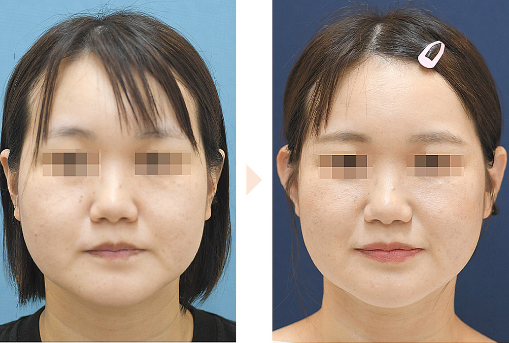 立ち耳による小顔治療（立ち耳にする整形）の症例写真・ビフォーアフター