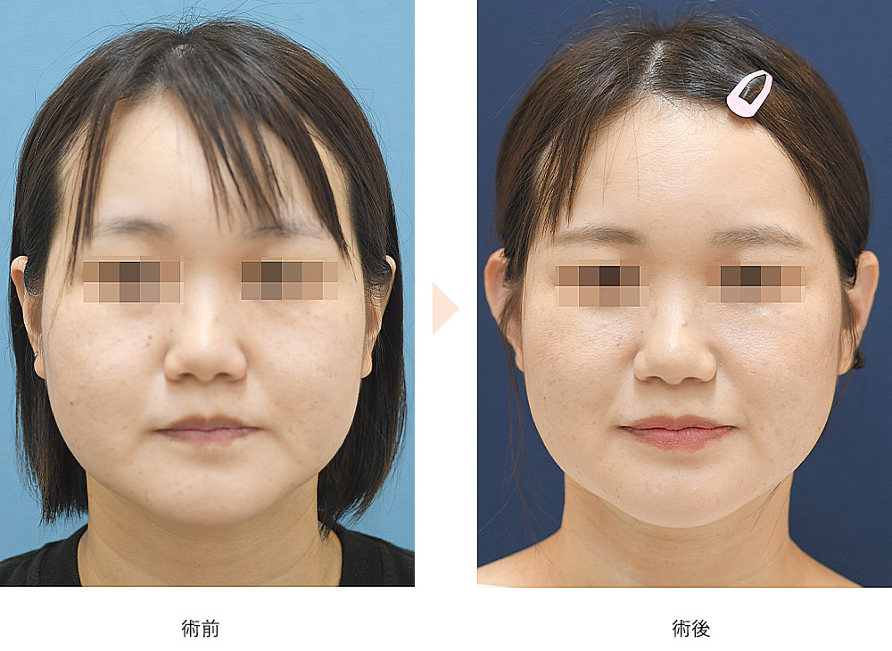 立ち耳整形（小顔・若見え効果）の症例写真・ビフォーアフター