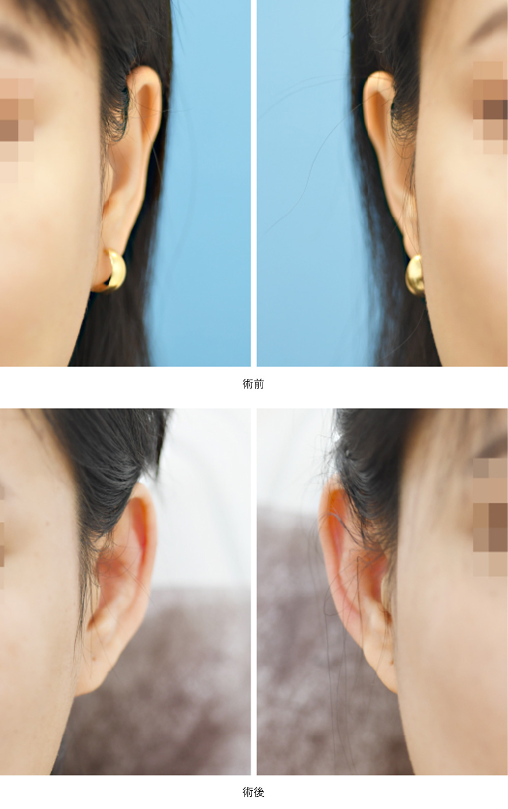 立ち耳フィラー(No.602)(小顔・幼さや若々しさアップ)の症例写真・ビフォーアフター