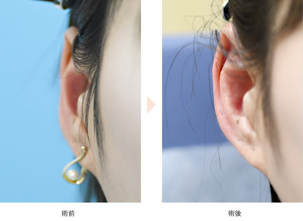 立ち耳フィラー(No.605)(生まれつき寝ている耳を前方に倒す)の症例写真・ビフォーアフター