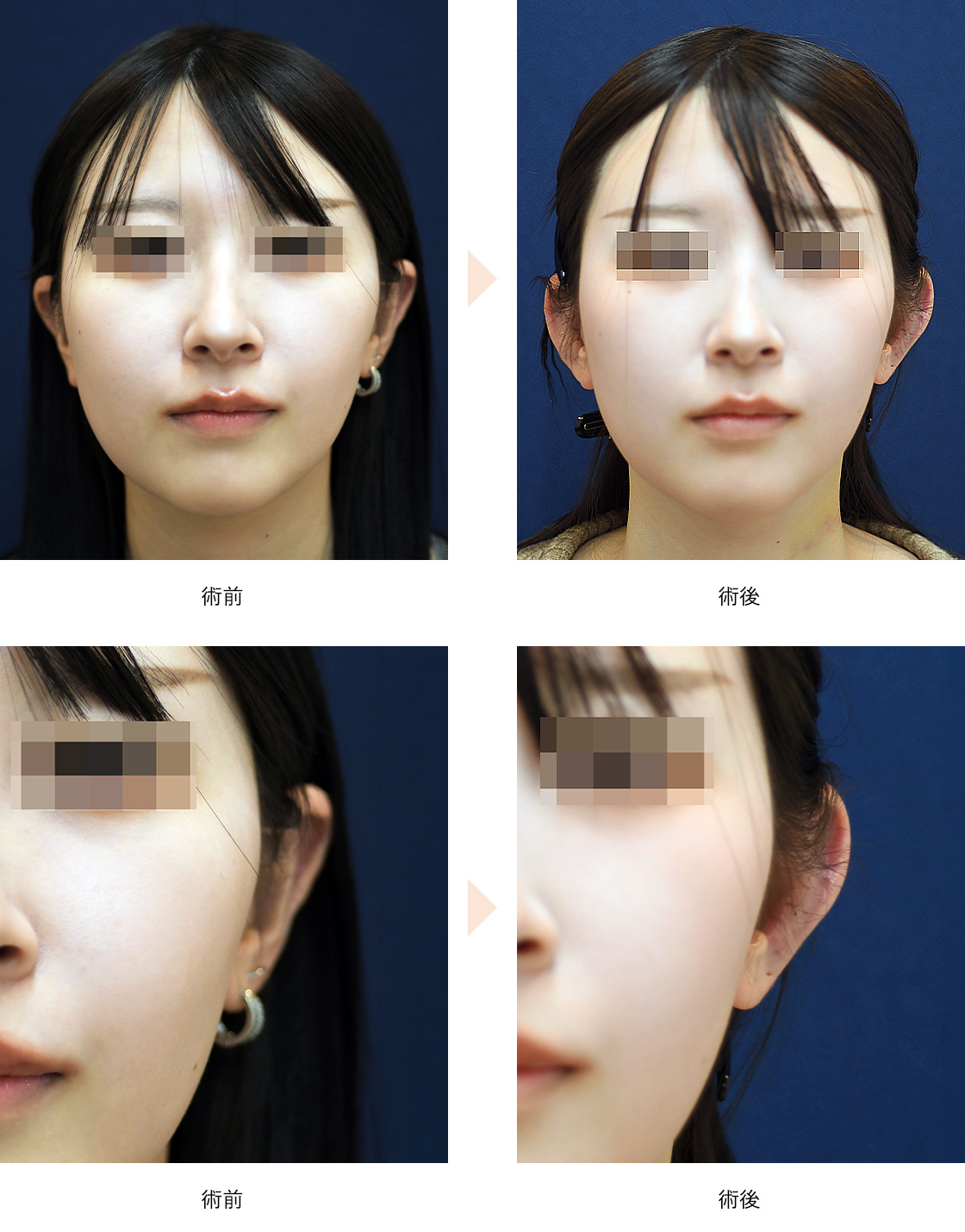 立ち耳整形／軟骨移植あり（No.660）（立ち耳にして小顔に見せる）の症例写真・ビフォーアフター