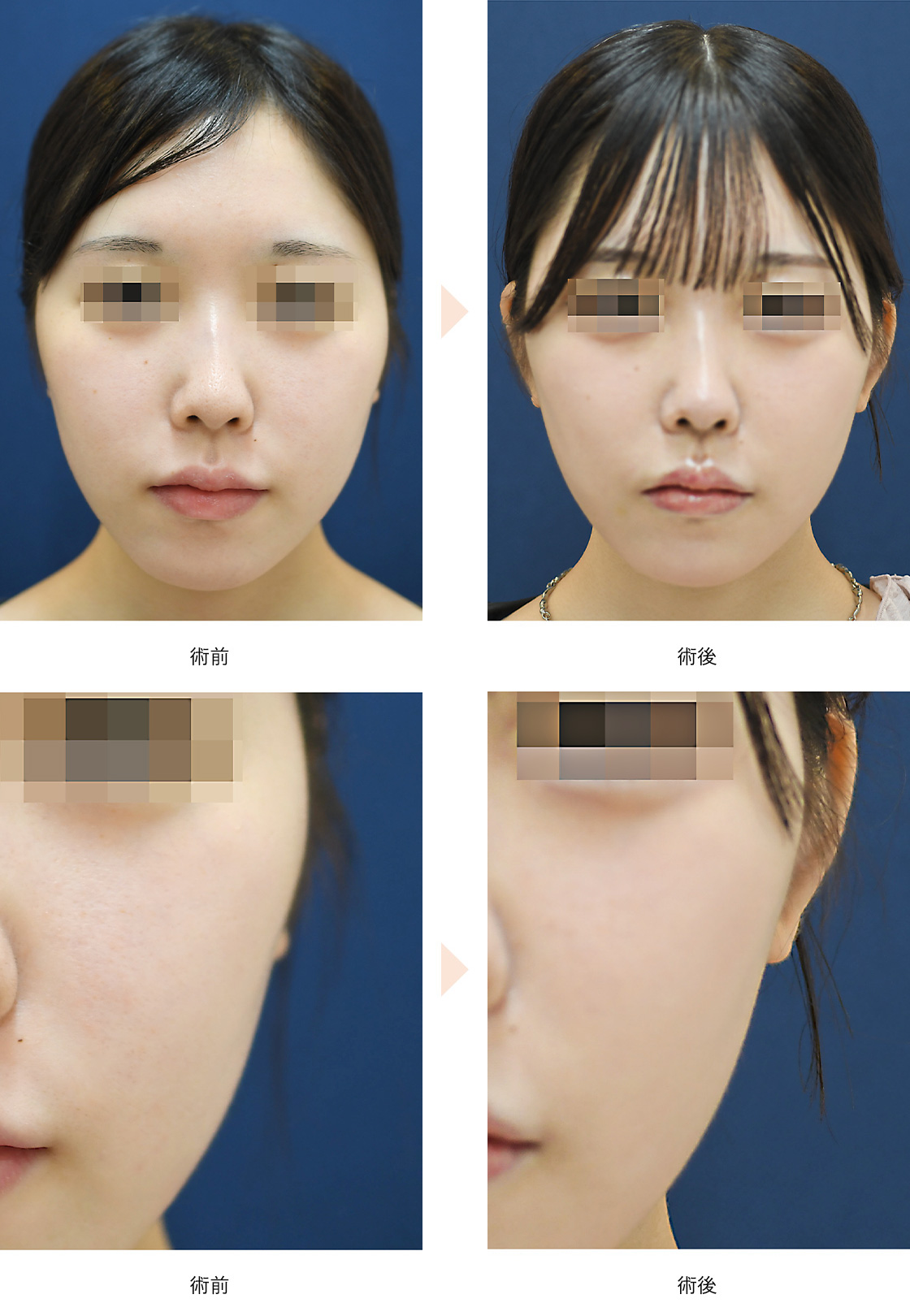 立ち耳整形(耳起こし/軟骨移植あり)(No.808)(正面から見えない耳の位置調整)の症例写真・ビフォーアフター