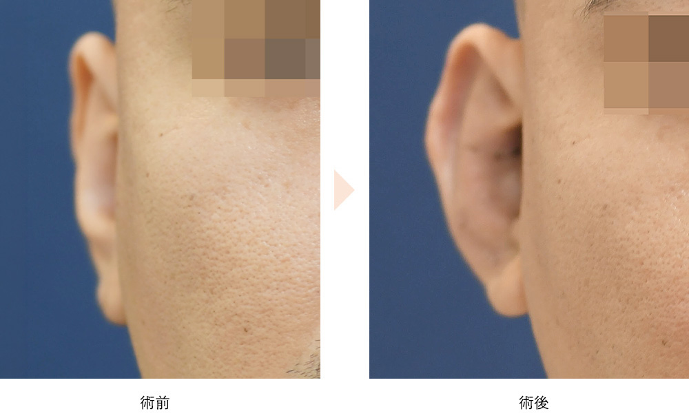 プロテーゼ挿入による耳起こし（立ち耳にする整形）の症例写真・ビフォーアフター