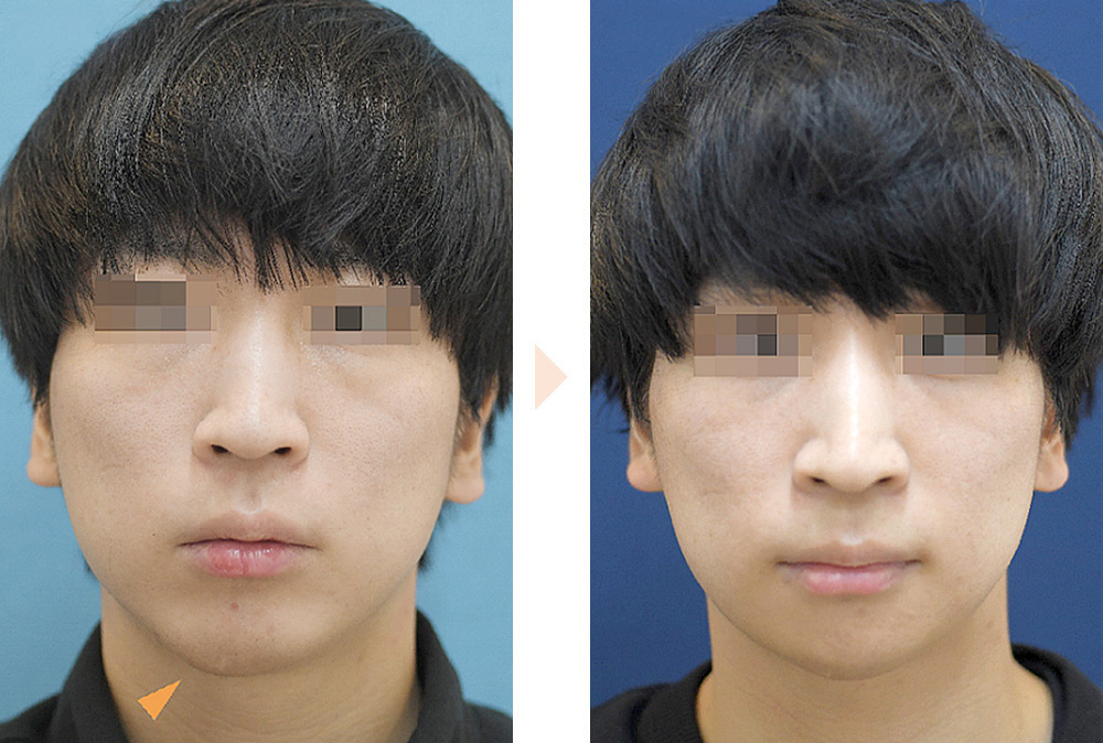 おとがい形成（顎先の短縮＋左右差改善）の症例写真・ビフォーアフター