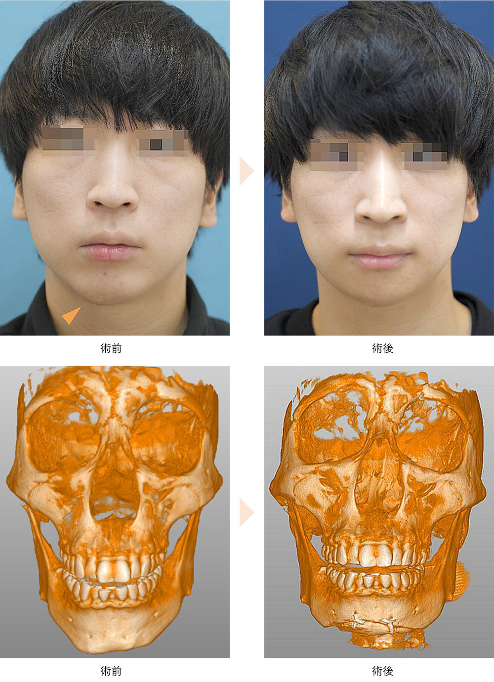 オトガイ形成/オトガイ水平骨切り(No.616)(顎を短くする+左右差を改善する)の症例写真・ビフォーアフター