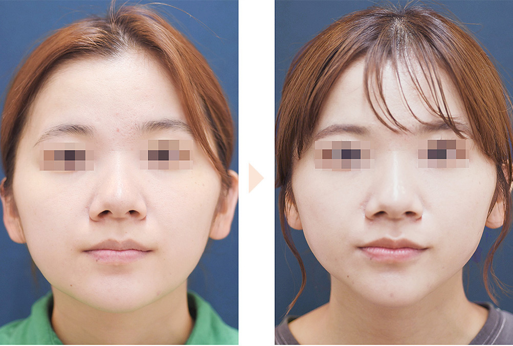 ジョールファット除去（Vライン形成／ベイザー使用）の症例写真・ビフォーアフター