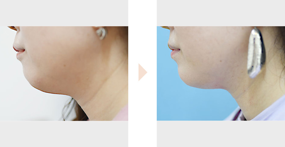 カベリン注射（脂肪溶解注射による顎下痩せ）の症例写真・ビフォーアフター