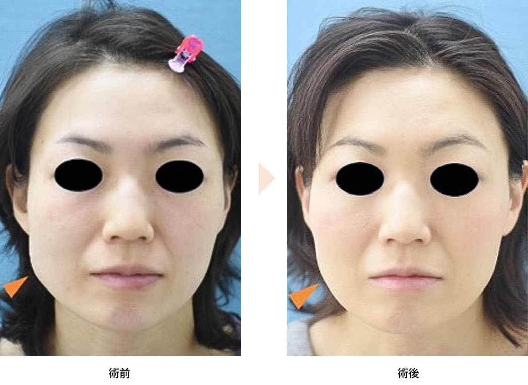 エラボトックスによる小顔治療（No.612）（左右差のある輪郭を改善）の症例写真・ビフォーアフター