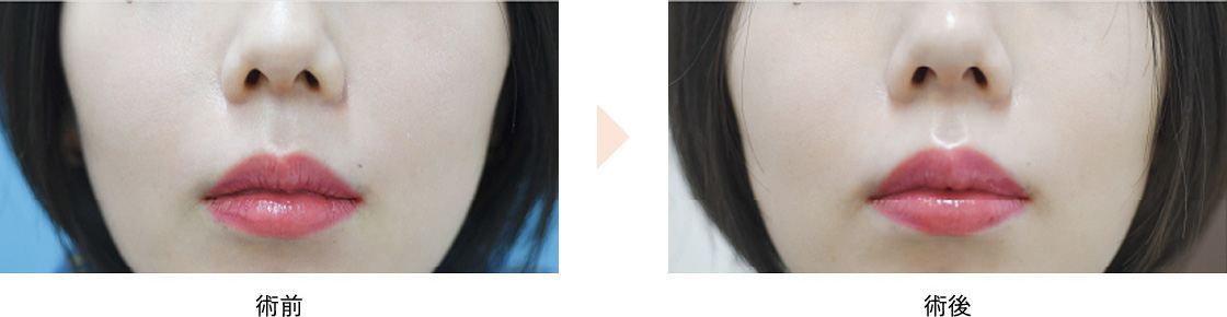 人中短縮ボトックス(No.545)(リップリフト)の症例写真・ビフォーアフター