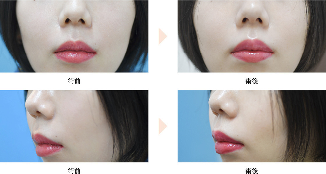 人中短縮ボトックス(No.545)(リップリフト)の症例写真・ビフォーアフター