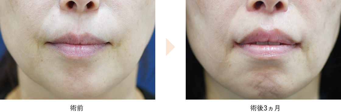 人中短縮・口角挙上(No.622)(皮膚切開/傷跡改善ボトックス併用)の症例写真・ビフォーアフター