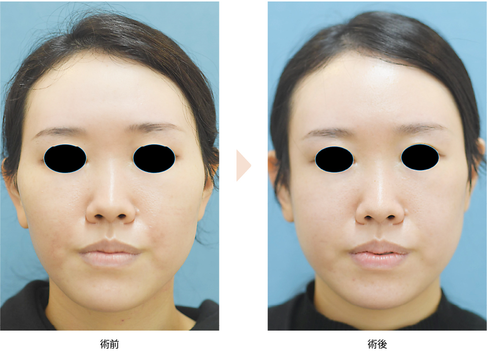 【頬骨骨切り・骨削りによる頬骨整形】（No.103）（頬の横方向への突出・顔の余白改善）」の症例写真・ビフォーアフター