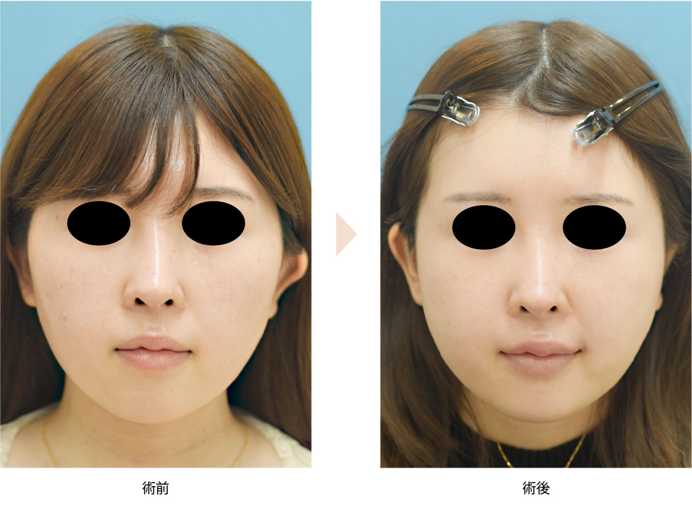 【頬骨骨切り・骨削りによる頬骨整形】（No.104）（頬の前方と横方向への突出・顔の左右幅改善）の症例写真・ビフォーアフター