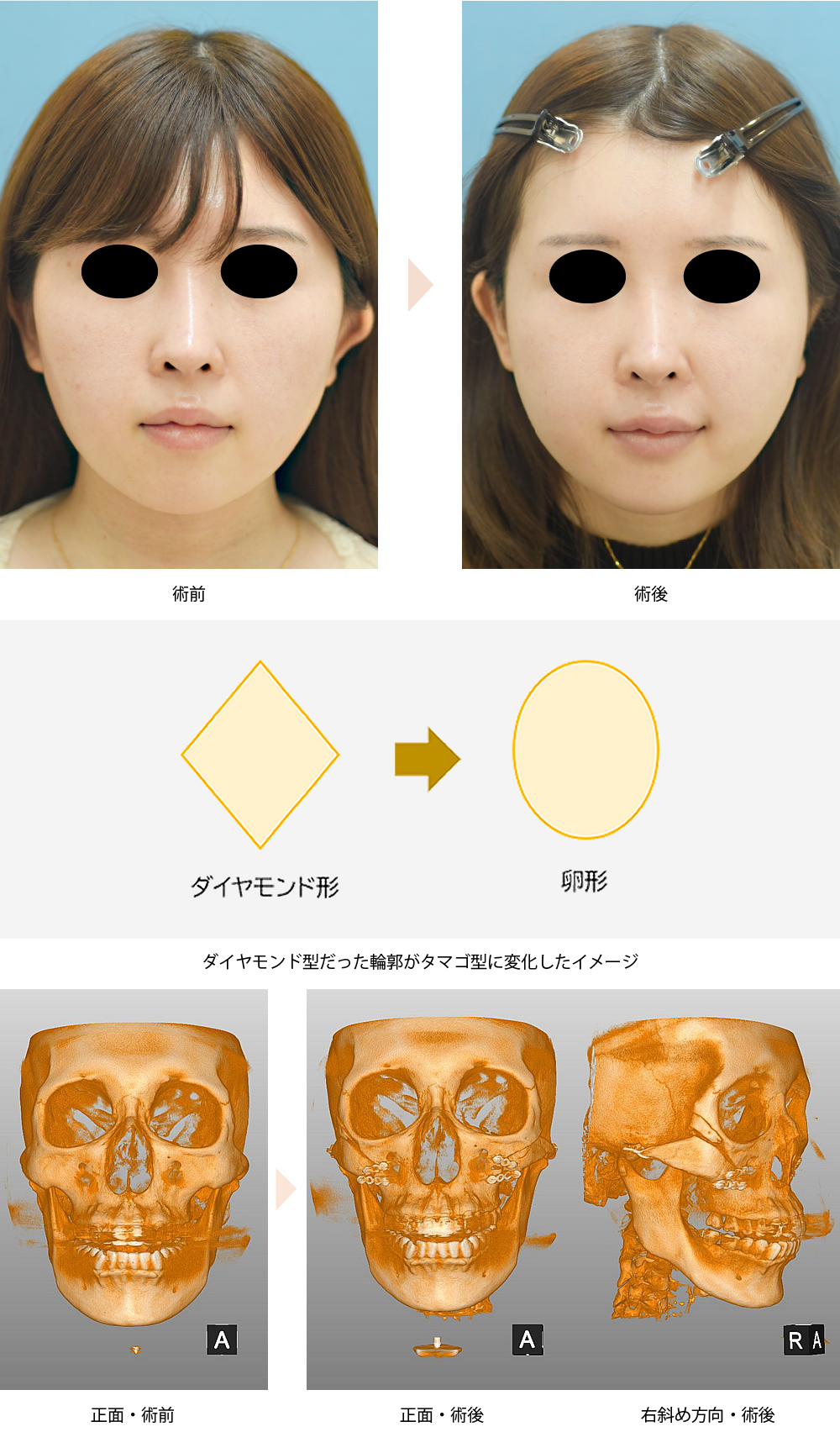 【頬骨骨切り・骨削りによる頬骨整形】（No.104）（頬の前方と横方向への突出・顔の左右幅改善）の症例写真・ビフォーアフター
