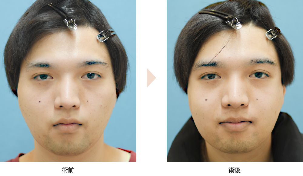 頬骨骨切り・骨削りによる頬骨整形（No.194）（中顔面の横幅を縮めて卵型の小顔に改善）の症例写真・ビフォーアフター