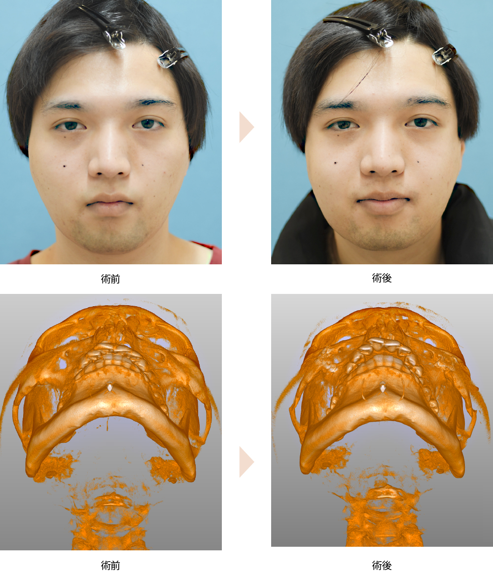 頬骨骨切り・骨削りによる頬骨整形（No.194）（中顔面の横幅を縮めて卵型の小顔に改善）の症例写真・ビフォーアフター
