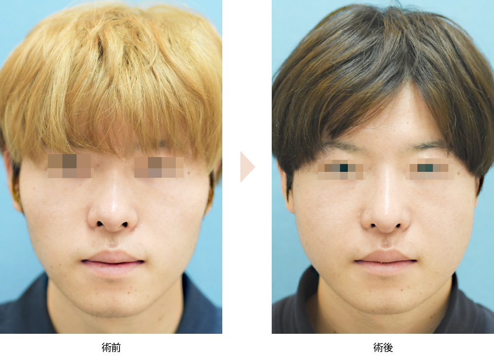 頬骨整形+エラ骨切り（No.288）（小顔効果と滑らかな輪郭形成）の症例写真・ビフォーアフター