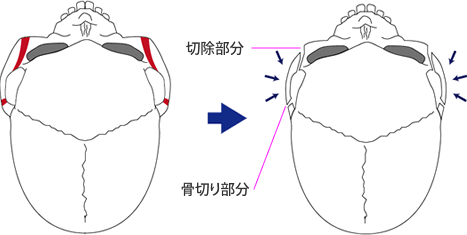 ２．頬骨が横方向（側面）に突出している場合