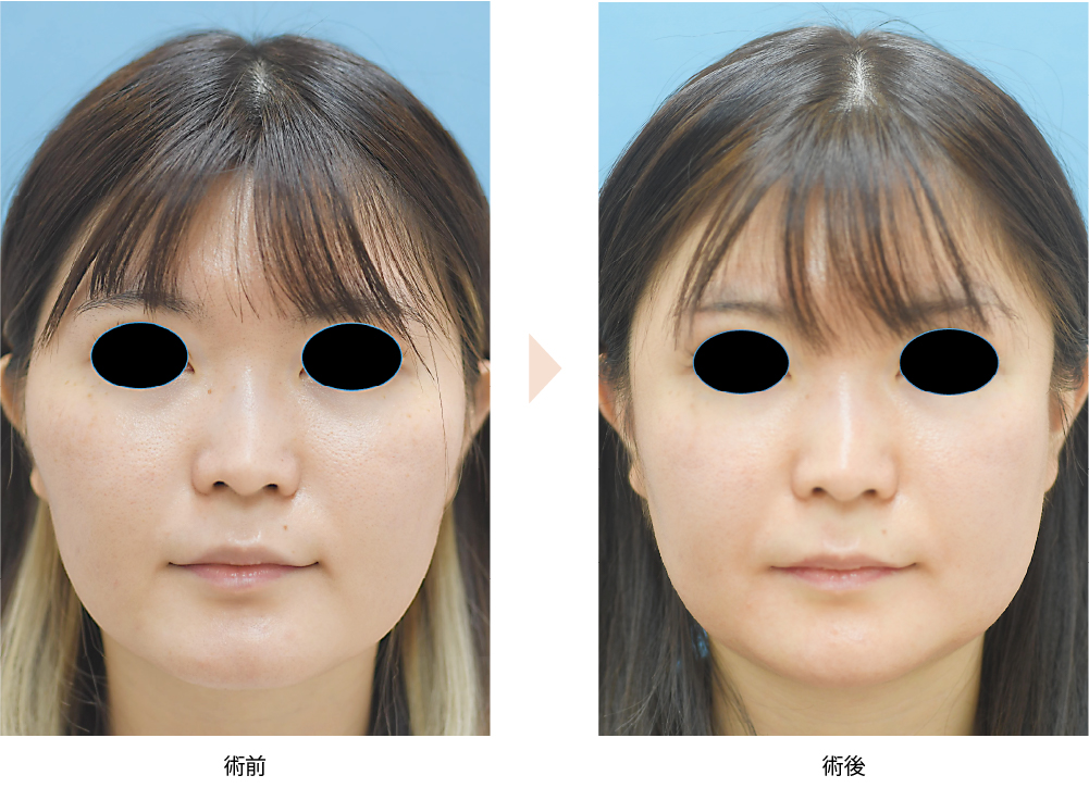 【頬骨骨切り・骨削りによる頬骨整形】（No.101）（頬の前方と横方向への突出・顔の左右幅改善）の症例写真・ビフォーアフター