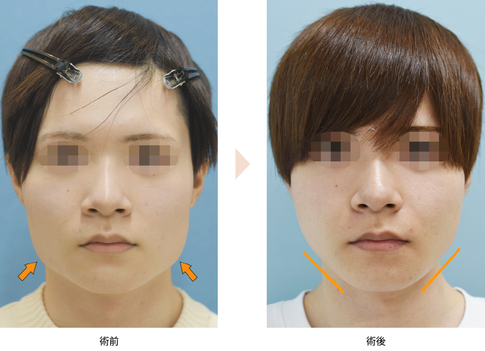 エラ（下顎角）骨切り術・下顎下縁形成術（No.170）の症例写真・ビフォーアフター
