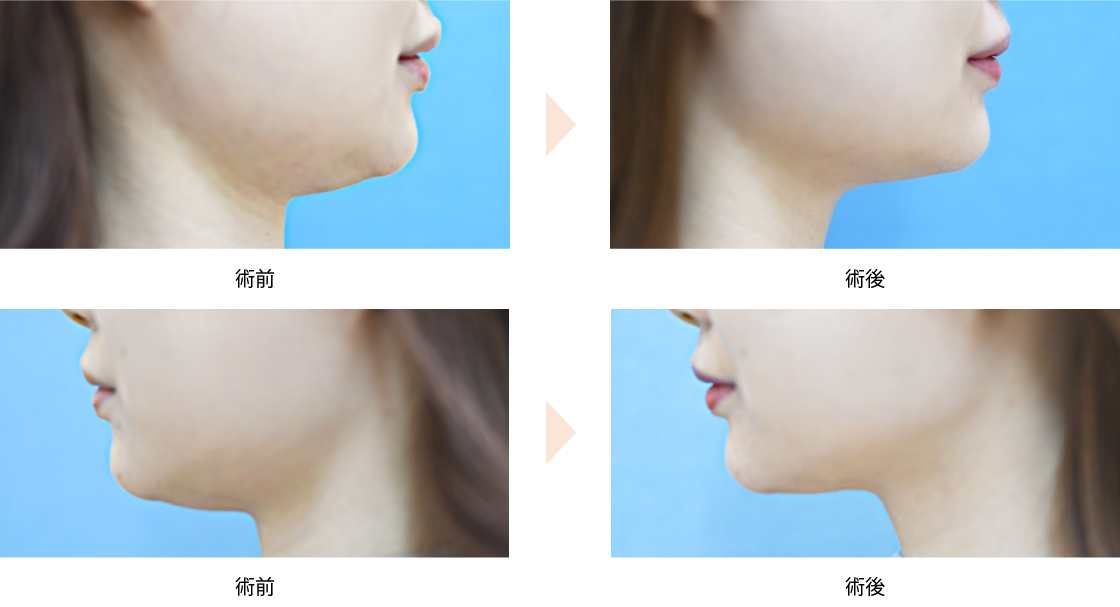 ボトックス注射による小顔治療 （No.298）（唾液腺ボトックス／舌下腺）の症例写真・ビフォーアフター