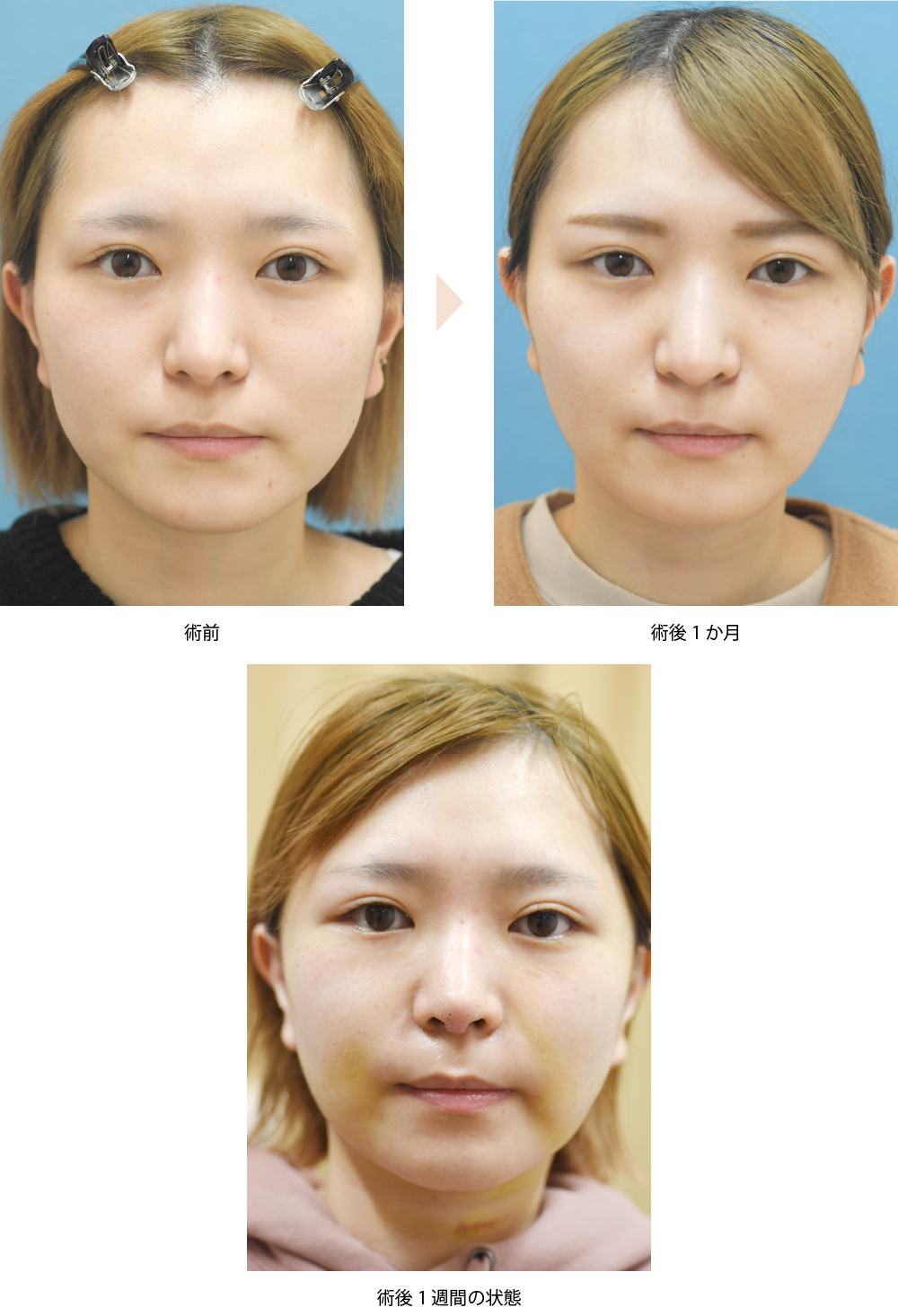 【ジョールファット（頬）除去・糸リフトの併用】（若い方の口元のたるみ改善・小顔治療例）」の症例写真・ビフォーアフター