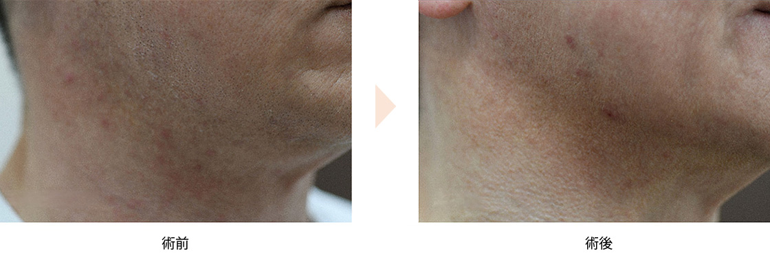 唾液腺ボトックスの症例写真・ビフォーアフター