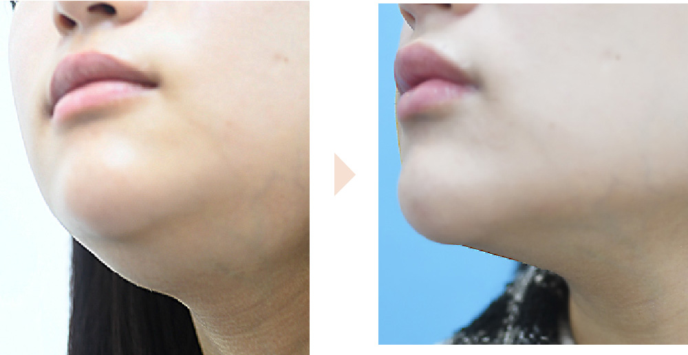 唾液腺ボトックスによる小顔治療（舌下腺・顎下腺）の症例写真・ビフォーアフター