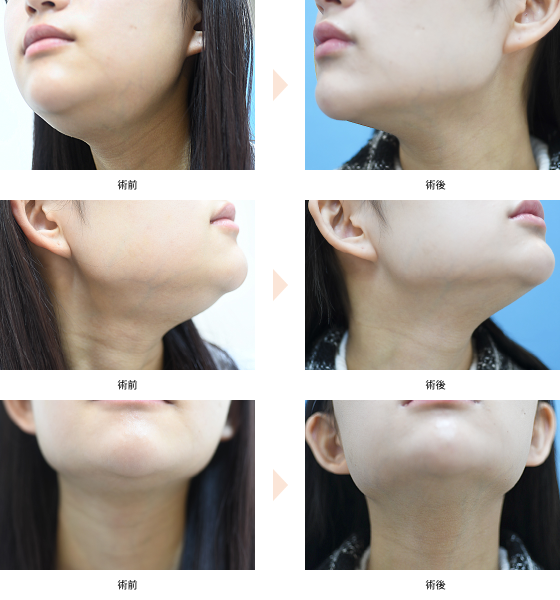 ボトックス注射による小顔治療 （No.265）（唾液腺ボトックス／舌下腺・顎下腺）の症例写真・ビフォーアフター
