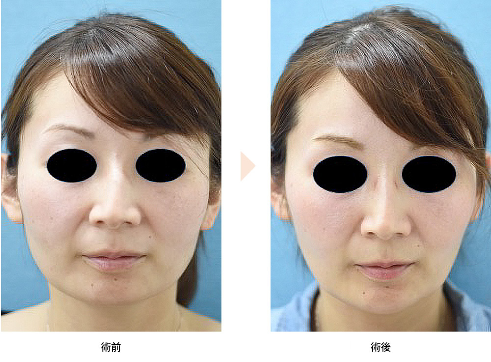 咬筋ボトックス（エラ取注射）による小顔治療（No.269）（小顔注射（咬筋ボトックス）／顎ヒアルロン酸）の症例写真・ビフォーアフター
